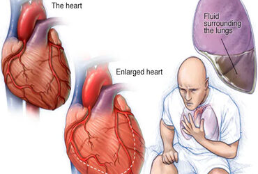 Recognizing Early Signs of Heart Failure: When to Seek Help