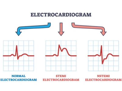 H2_ What is an ECG Test and Why Is It Important for Heart Screening