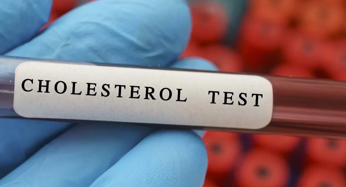 imgi_192_cholesterol-blood-test--conceptual-image-204354690-1x1 - AHF Clinic